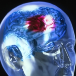 Что нужно знать о кровоизлиянии в мозг