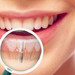 Зубные имплантаты: их разновидности