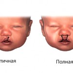 Самые частые аномалии полости рта