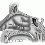 Полипы носа: причины появления и лечение