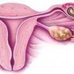 Апоплексия яичника: проявление и лечение