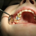 Плохой зуб: лечить или удалять