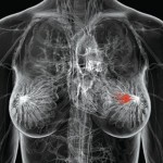 Рак молочной железы и менопауза: есть ли связь
