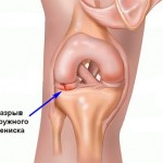 Разрыв мениска: как лечить