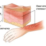 Ожог: как помочь до прихода врача