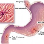 Язвенная болезнь желудка: берегитесь осложнений