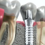 Зубные импланты или протезы: что надежнее