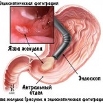 Причины развития язвы двенадцатиперстной кишки и желудка