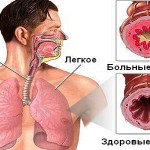 Бронхиальная астма: как возникает болезнь