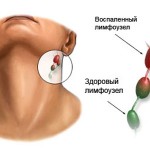 Почему воспаляются лимфатические узлы