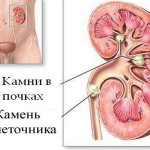 Пиелолитотомия: избавление от почечных камней