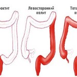 Как лечить хронические формы колита