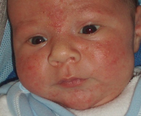 Аллергия у малыша