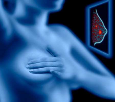 Факторы риска рака молочной железы