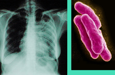 Что поражает туберкулез