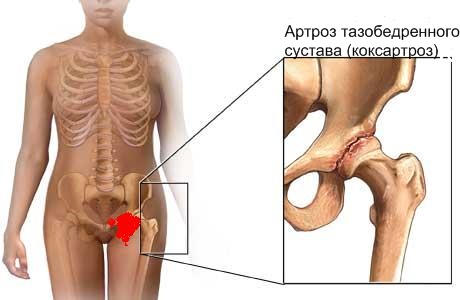 Как вылечить остеоартроз тазобедренных суставов