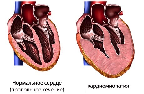 Что такое кардиомиопатия