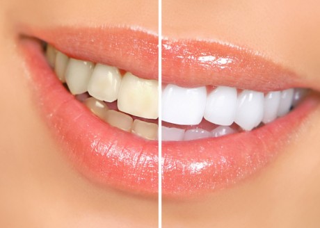 Перед отбеливанием производится оценка состояния зубов