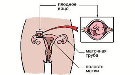 Внутриматочная беременность