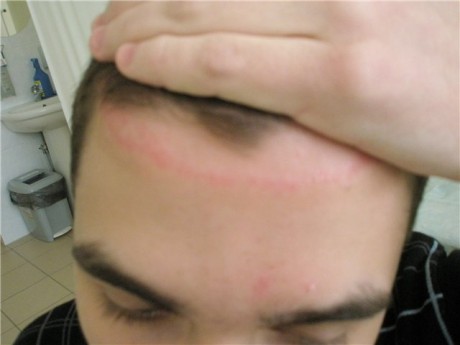 Псориаз – инфекционное заболевание кожи