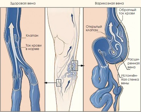 Силовые тренировки при варикозе