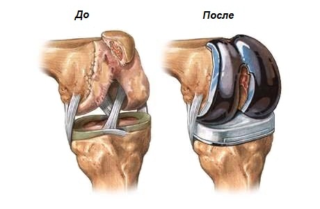 Протезирование коленного и тазобедренного суставов