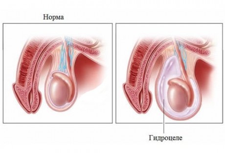  Симптомы гидроцеле  