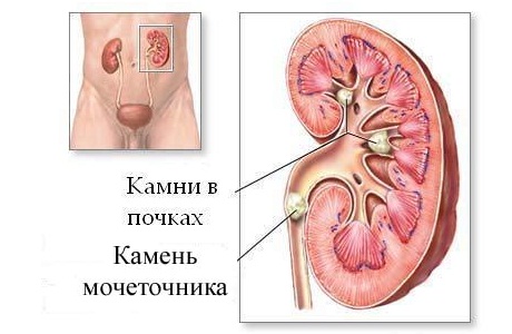 Камни в почках: причины появления, симптоматика