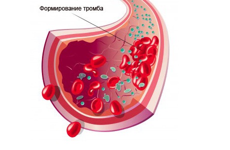 Тромбофлебит глубоких вен: симптомы и причины