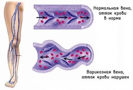 Что такое варикоз  