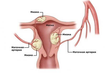 Насколько опасна миома матки  