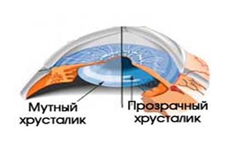 катаракта