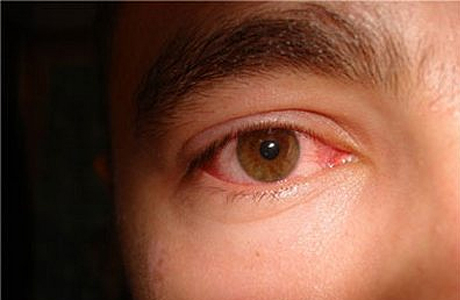 синдром красных глаз
