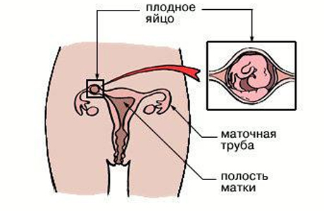 Внематочная беременность