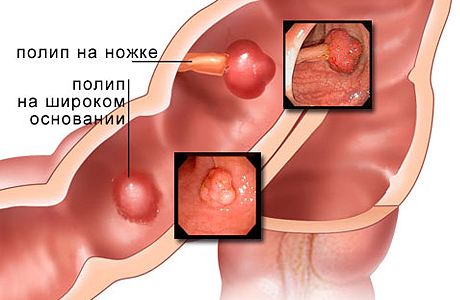 Полипы