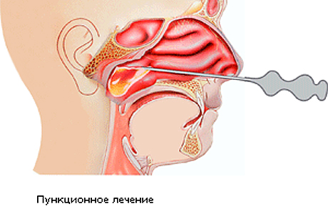 Пункционное лечение