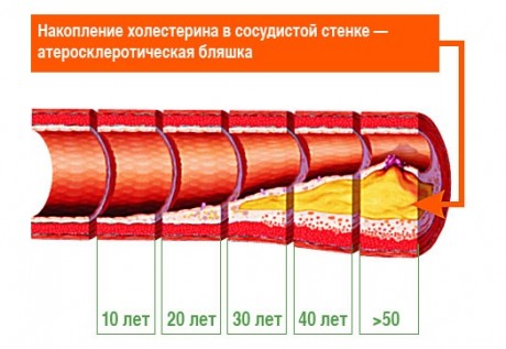 Что такое атеросклеротическая бляшка