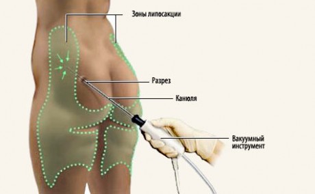 Липосакция: основная характеристика процедуры