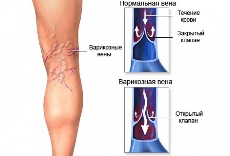 Причины развития варикоза