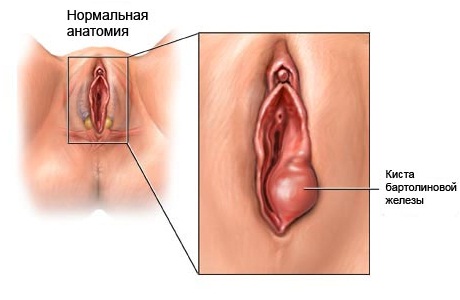 Киста бартолиновой железы: общая характеристика