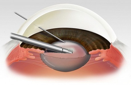Как лечить катаракту