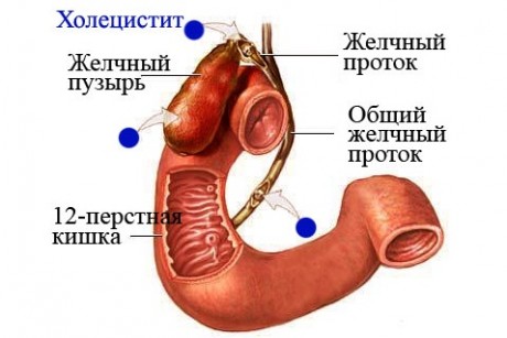 Холецистит: симптомы, причины, лечение