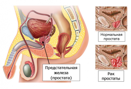 Рак предстательной железы