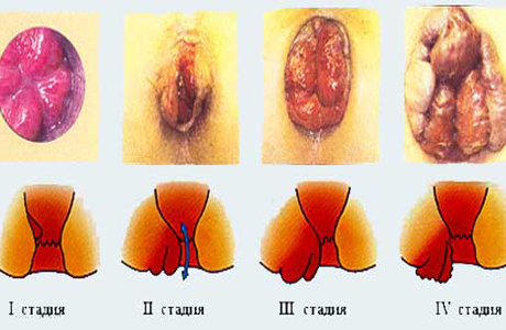 Не откладывайте лечение геморроя