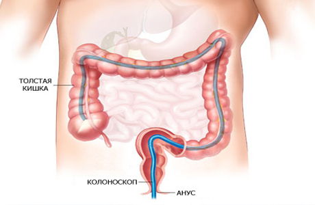 Колоноскопия - эндоскопическая диагностика болезней толстой кишки