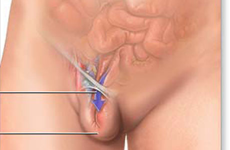 Паховая грыжа - дефект в брюшной стенке и паховой зоне