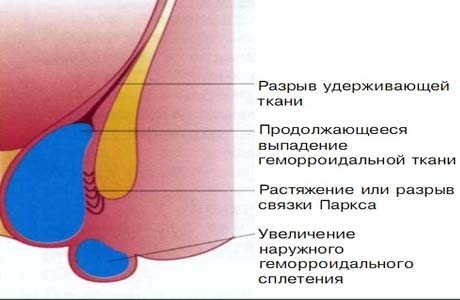 Как лечить геморроидальные узлы